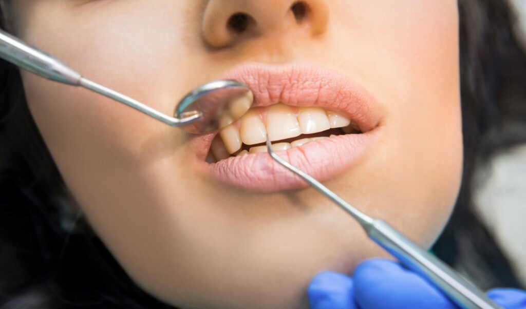 Teeth, probe and mouth mirror